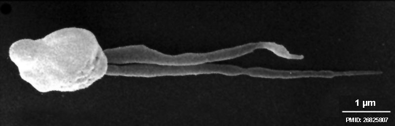 File:Human sperm pathology EM02.jpg