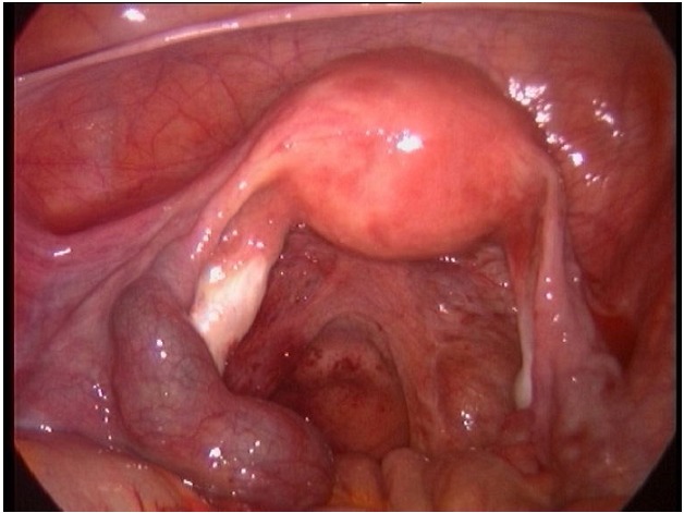 File:Unruptured ampullary ectopic pregnancy at laparoscopy.jpg