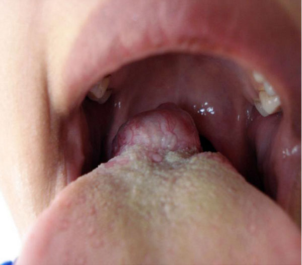 File:Ectopic thyroid - lingual 01.jpg