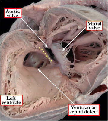 File:Ventricular Septal Defect (VSD).jpeg