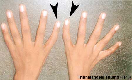 Triphalangeal-thumb.jpg