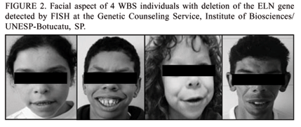 File:Facial features of four individuals with Willams Syndrome.gif