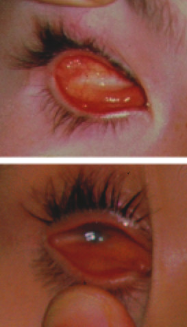 File:Anophthalmia and microphthalmia.jpg