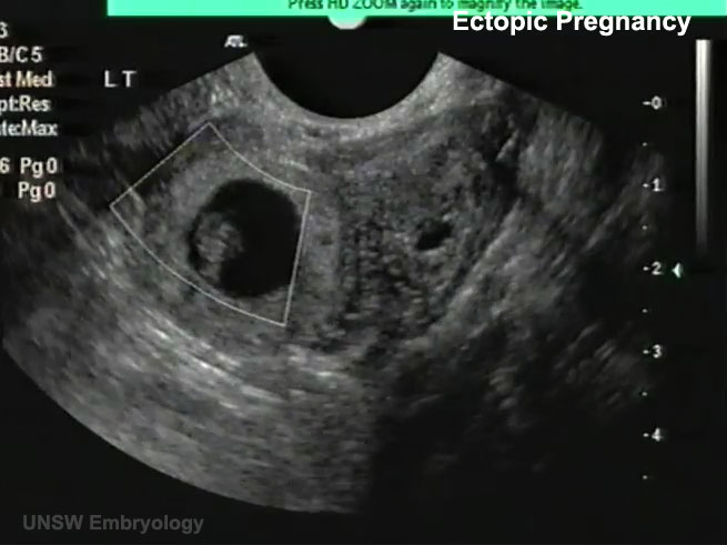 Ectopic Pregnancy Ultrasound