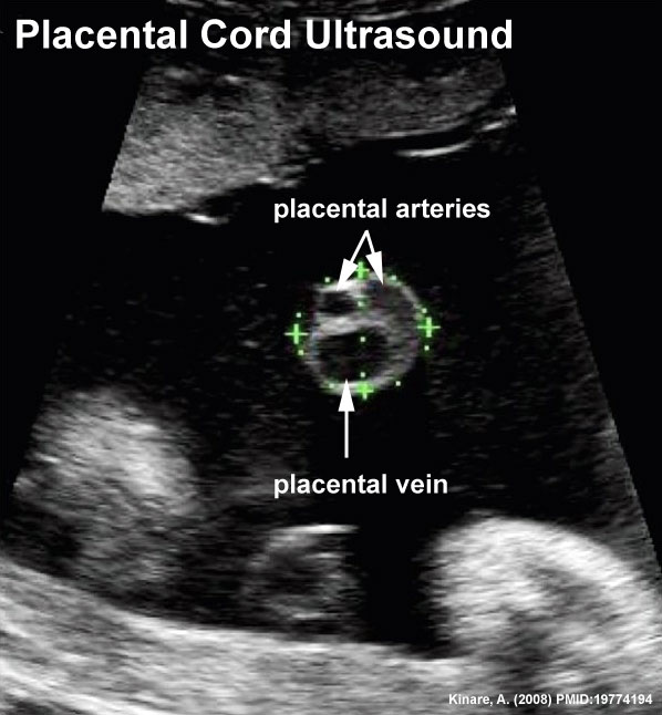 Placental cord ultrasound 03.jpg