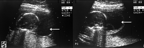 Turner Syndrome Test Showing Cystic Hygroma.gif