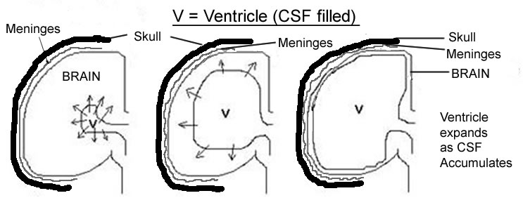 File:Ventricle Expansion.jpg
