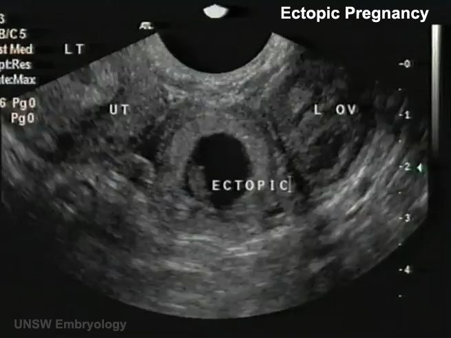 FileEctopic 01.jpg Embryology