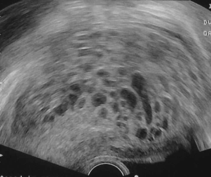 File:Hydatidiform mole ultrasound 01.jpg