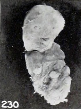 File:Mall Meyer1921 fig230.jpg