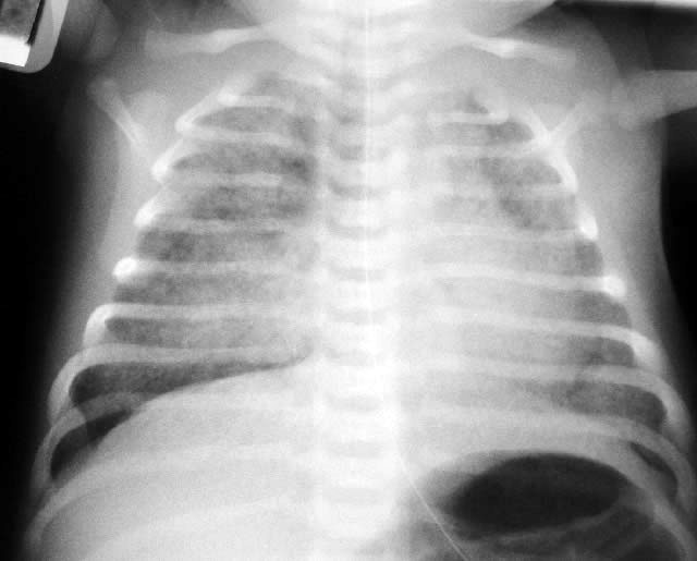 File:Meconium aspiration syndrome x-ray.jpg