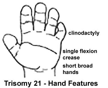 File:Trisomy21 hand.jpg