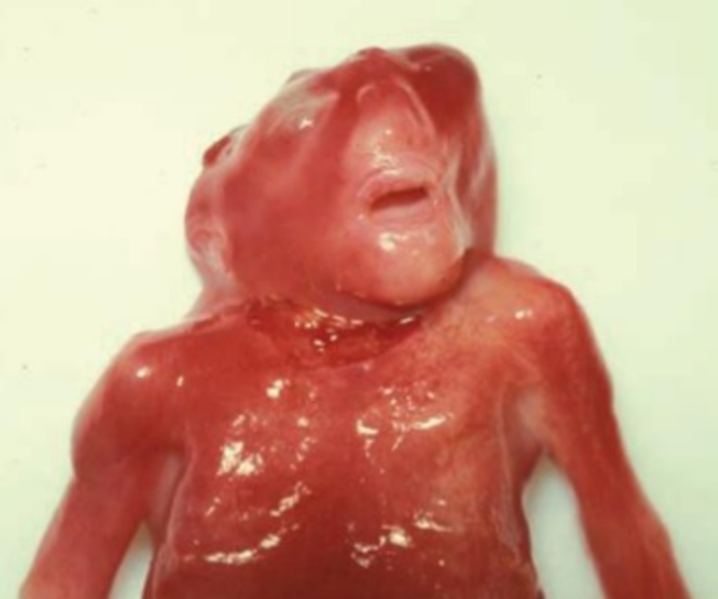 File:Anencephaly.png