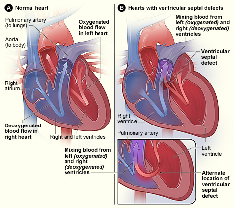 File:Congenital Heart Disease.jpg