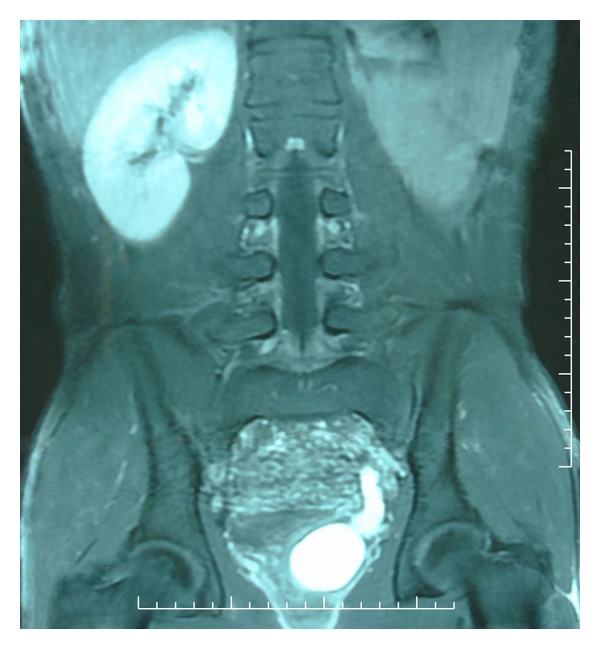 MRI renal agenesis .jpg