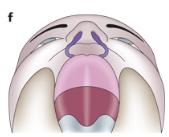 File:Bilateral cleft lip.jpg