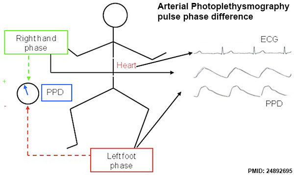 File:PDA arterial photoplethysmography.jpg