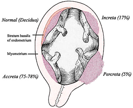 Placenta abnormalities.jpg
