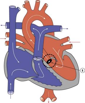 File:Aortic Stenosis.jpg