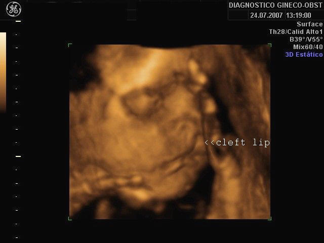 3D ultrasound image showing a fetus with a cleft lip abnormality