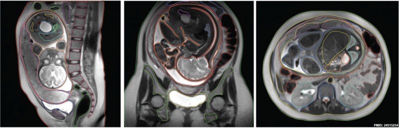 File:Fetal 9 month MRI 01.jpg