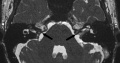 Bilateral Stenosis of Internal Auditory Canal