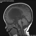 Infant with obstructive congenital hydrocephalus Existing website image.