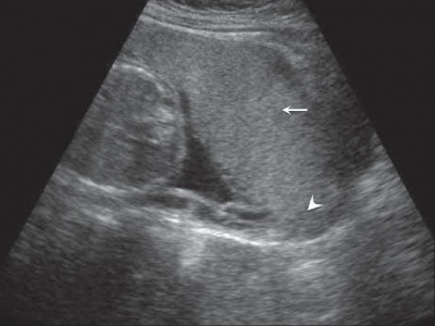 Placenta previa - anterior.jpg