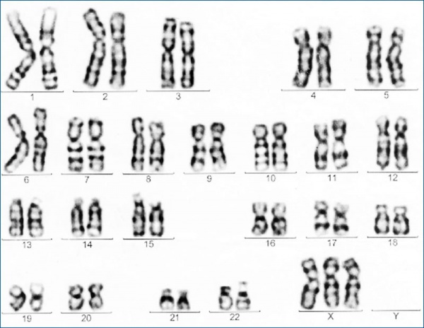 Trisomy X karyotype.jpg