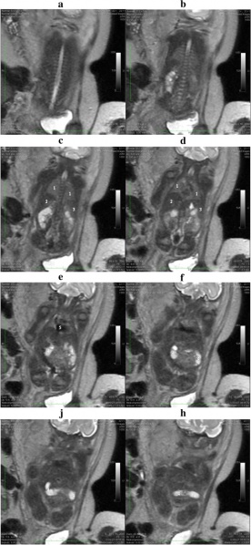 File:MRI confirming renal agenesis.jpg