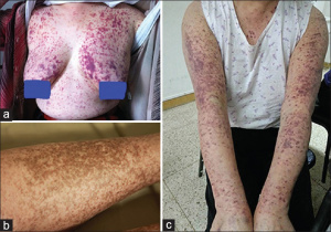 patient with sjogren syndrome,"(a and c) Photographs of the same patient. (b) Chronic purpuric eruption on pretibial area".