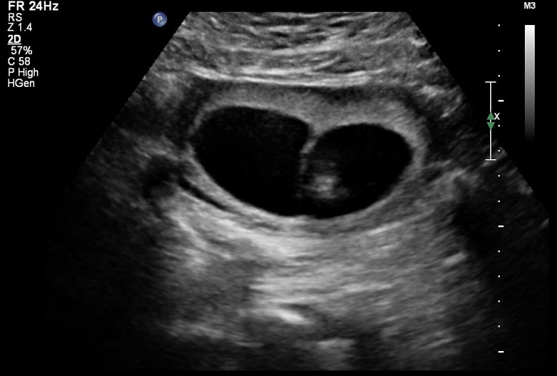 File:Ultrasound twinning 01.jpg