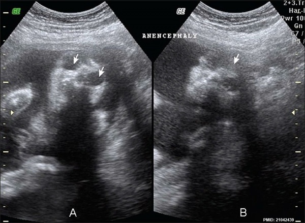 Anencephaly ultrasound.jpg