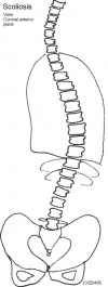 Scoliosis drawn.jpg