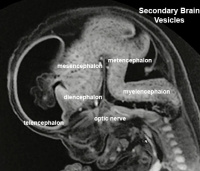Stage23 MRI S01-vesicles.jpg