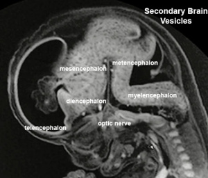 Stage23 MRI S01-vesicles.jpg