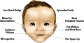 Fetal alcohol syndrome Z3418981 Figure relates to project topic and contains reference, copyright and student template. There should have been more information contained in the figure caption. File name should have been better identified of content (Fetal alcohol syndrome facial features).
