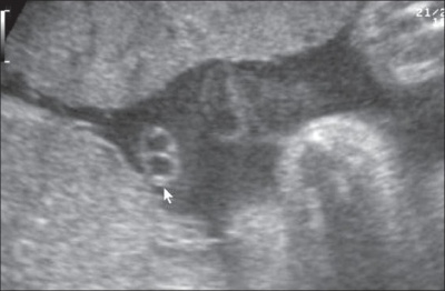 Placental cord ultrasound 02.jpg