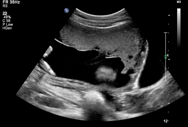 File:US Circumvallate placenta 02.jpg