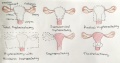 Surgeries on the reproductive system in women Z3463667 Student-drawn image relevant to project. Includes source information and student template. Well designed figure explaining terminology.