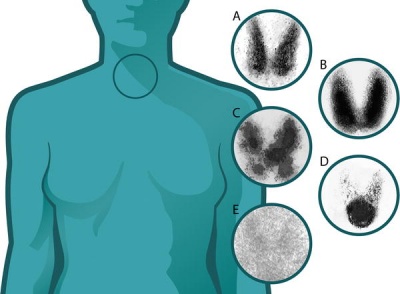 Thyroid uptake scans .jpg