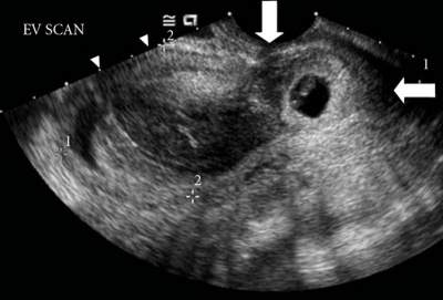 Cervical ectopic ultrasound.jpg