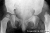 Congenital dislocation hip