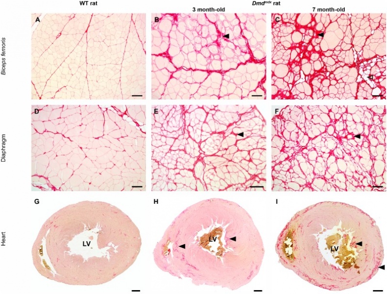 File:Progressive myofiber replacement by fibrotic and fat tissue in Dmdmdx rats..jpg