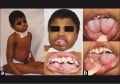 Image shows an example of tongue abnormalities, this is called "double tongue" each side has independent movement!