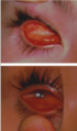 Clinical appearance of anophthalmia and microphthalmia (upper picture: anophthalmia, lower picture:microphthalmia)