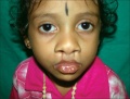 Picture shows Van der Woude syndrome with lower lip pits-Most common syndrome associated with cleft