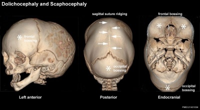 Skull CT abnormal 01.jpg