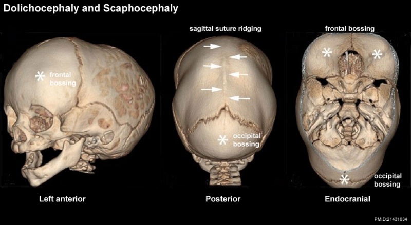 File:Skull CT abnormal 01.jpg