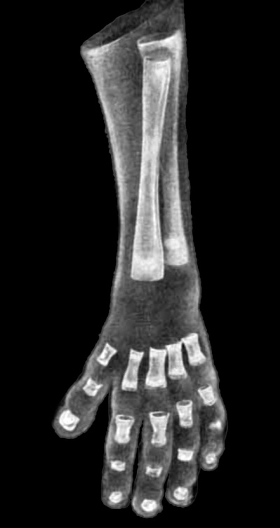 Fig.6. Hand of embryo No. 300 (73 mm. long)